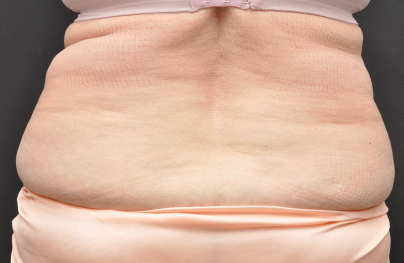 Liposuction Before and After | Northside Plastic Surgery