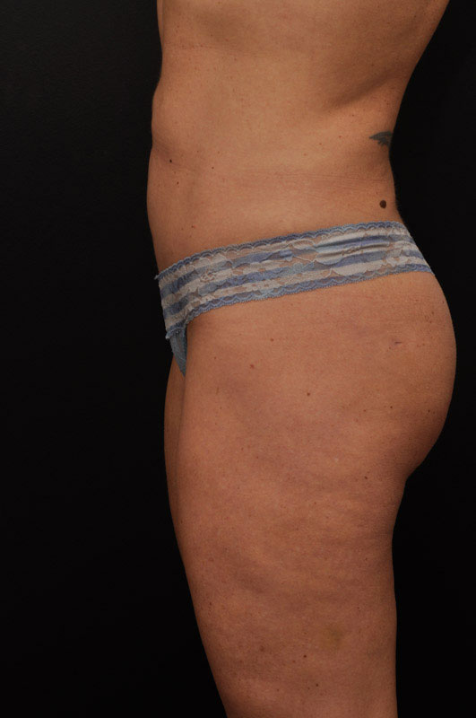 Liposuction Before and After | Northside Plastic Surgery