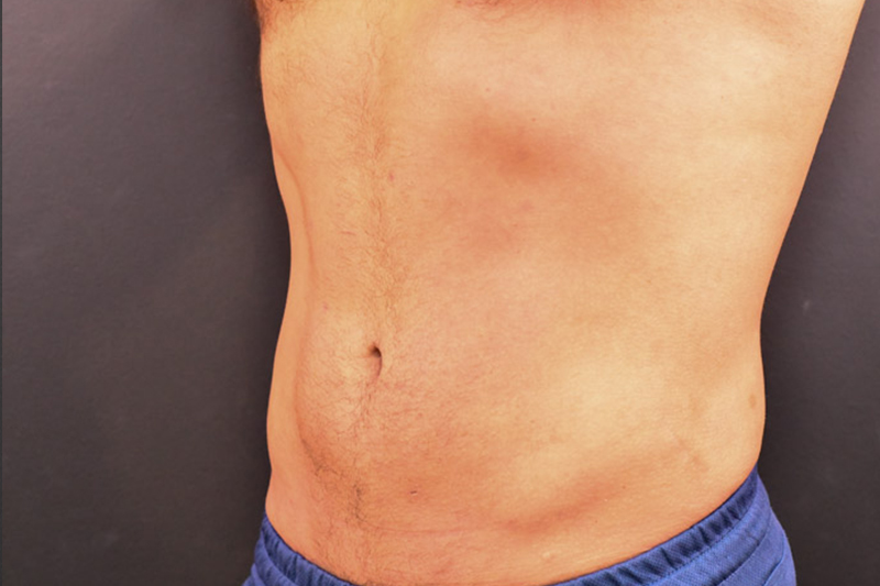 Liposuction Before and After | Northside Plastic Surgery