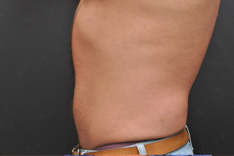 Liposuction Before and After | Northside Plastic Surgery