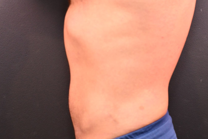 Liposuction Before and After | Northside Plastic Surgery