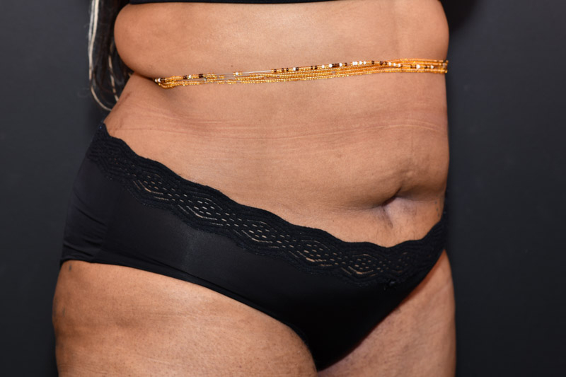 Liposuction Before and After | Northside Plastic Surgery