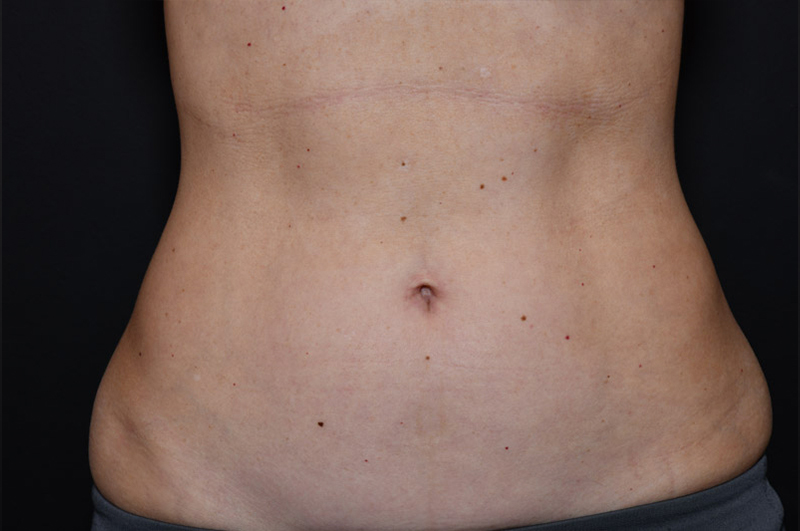 Liposuction Before and After | Northside Plastic Surgery