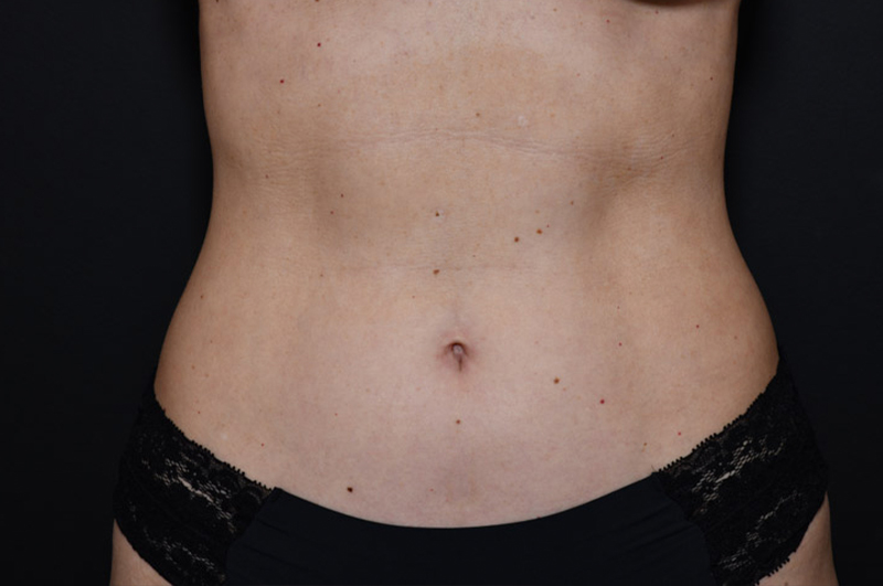 Liposuction Before and After | Northside Plastic Surgery