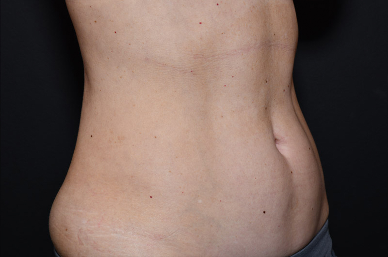 Liposuction Before and After | Northside Plastic Surgery