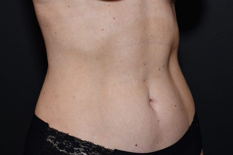 Liposuction Before and After | Northside Plastic Surgery