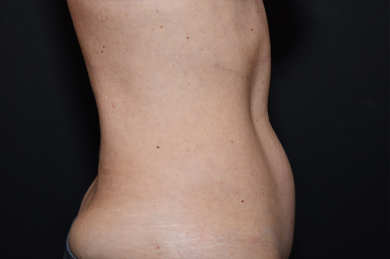 Liposuction Before and After | Northside Plastic Surgery