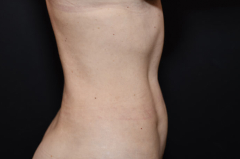 Liposuction Before and After | Northside Plastic Surgery