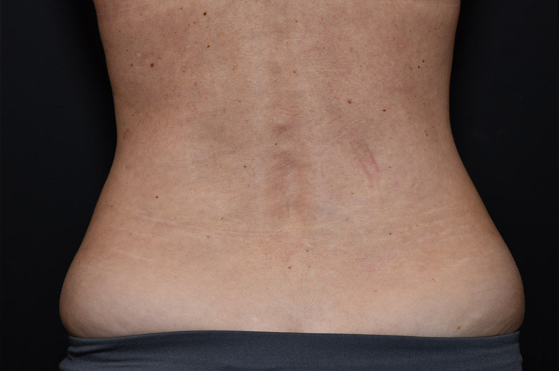 Liposuction Before and After | Northside Plastic Surgery