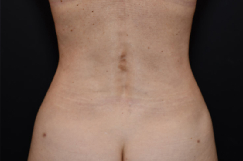 Liposuction Before and After | Northside Plastic Surgery