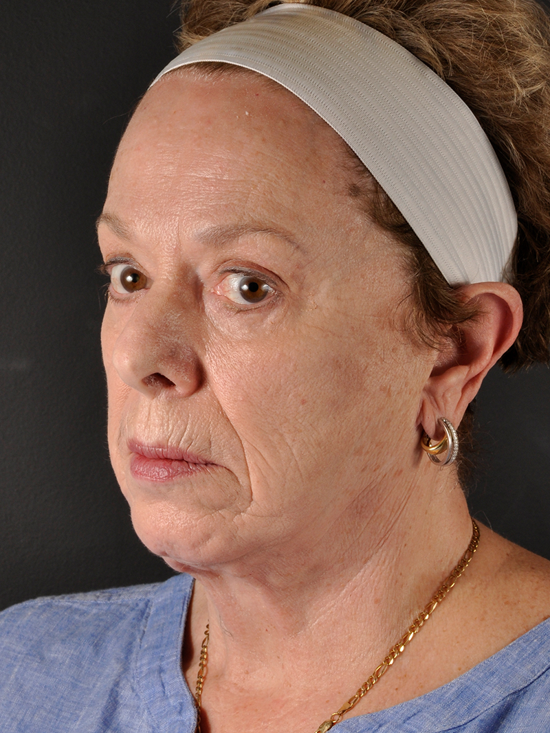 Natural Browlift Before and After | Northside Plastic Surgery