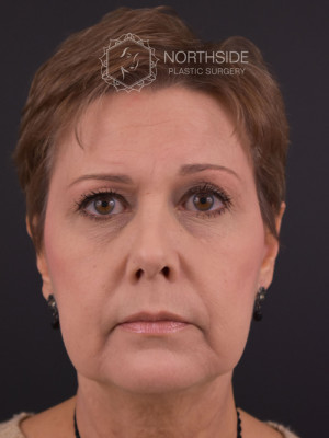 Natural Browlift Before and After | Northside Plastic Surgery