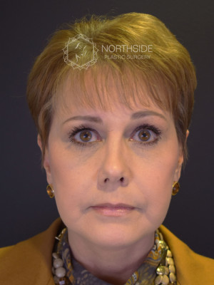 Natural Browlift Before and After | Northside Plastic Surgery