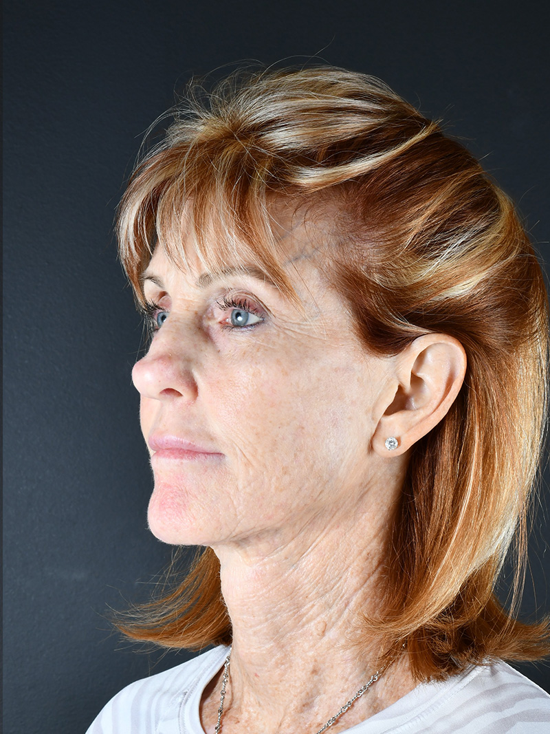 Natural Browlift Before and After | Northside Plastic Surgery