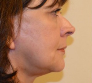 Natural Browlift Before and After | Northside Plastic Surgery