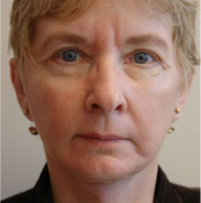 Natural Browlift Before and After | Northside Plastic Surgery