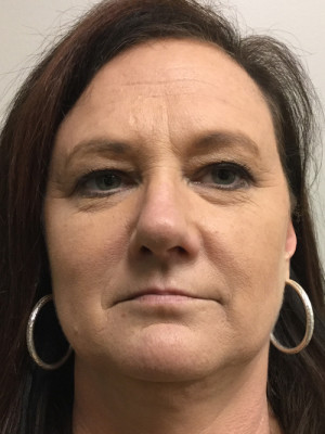 Natural Browlift Before and After | Northside Plastic Surgery