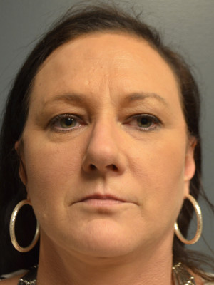 Natural Browlift Before and After | Northside Plastic Surgery