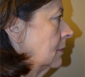 Natural Browlift Before and After | Northside Plastic Surgery