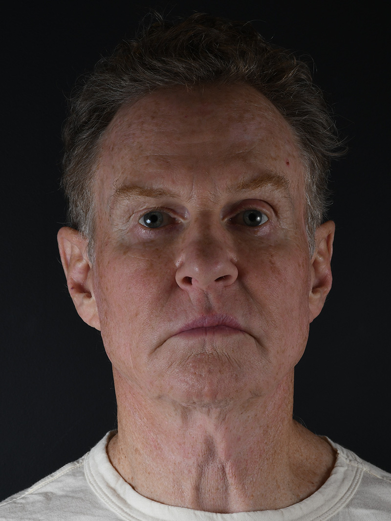 Natural Browlift Before and After | Northside Plastic Surgery