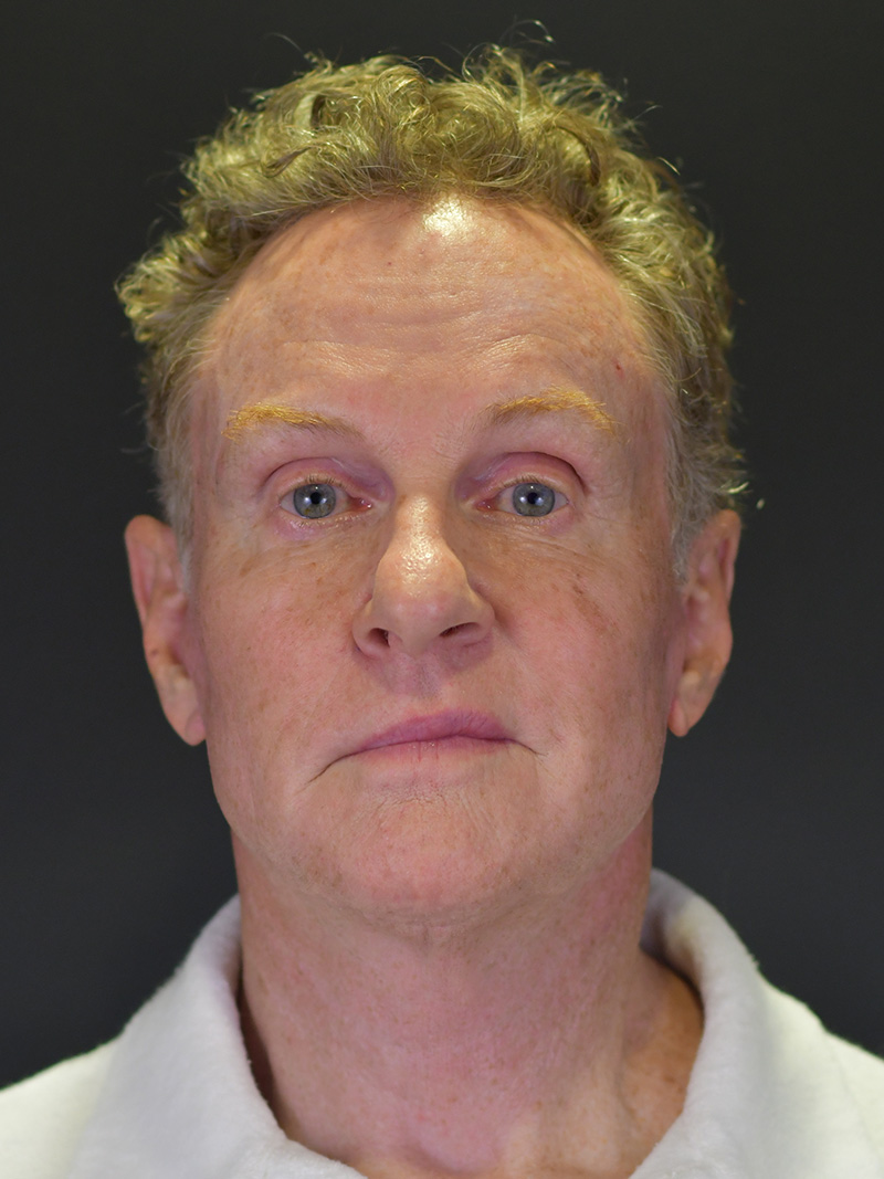 Natural Browlift Before and After | Northside Plastic Surgery