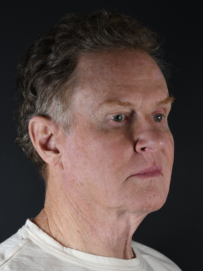 Natural Browlift Before and After | Northside Plastic Surgery