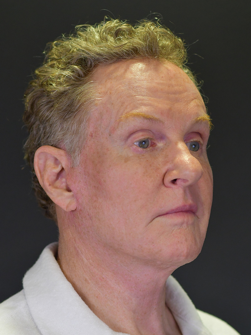 Natural Browlift Before and After | Northside Plastic Surgery