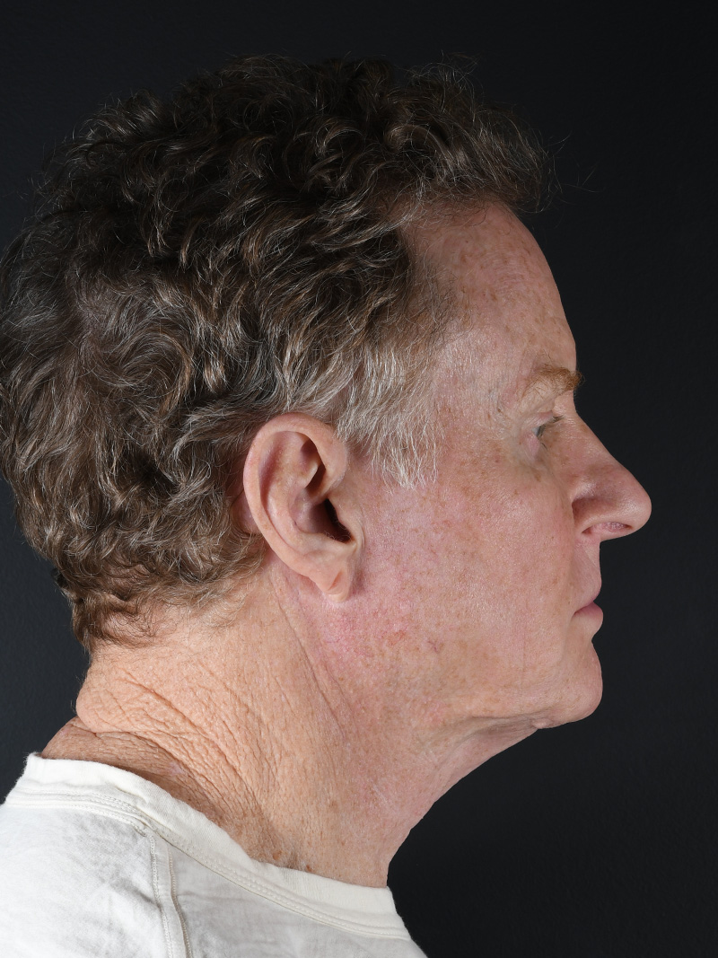 Natural Browlift Before and After | Northside Plastic Surgery