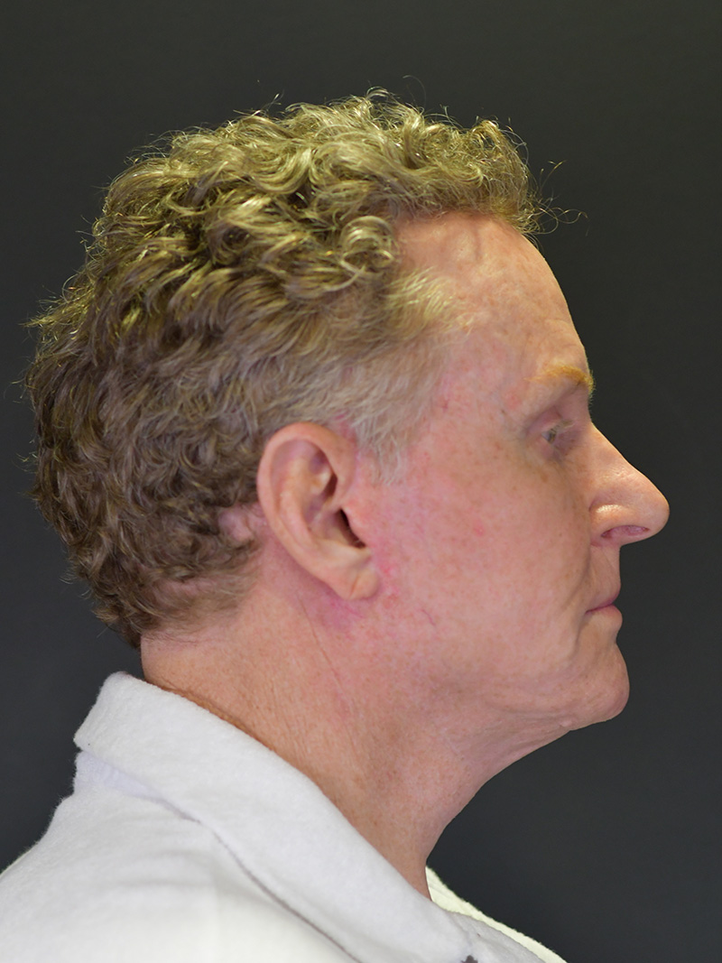 Natural Browlift Before and After | Northside Plastic Surgery