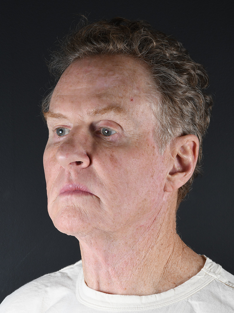 Natural Browlift Before and After | Northside Plastic Surgery