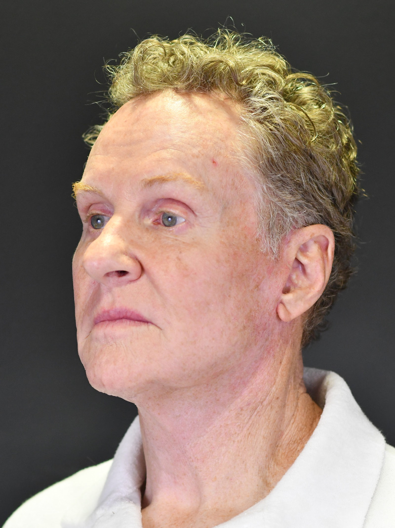 Natural Browlift Before and After | Northside Plastic Surgery