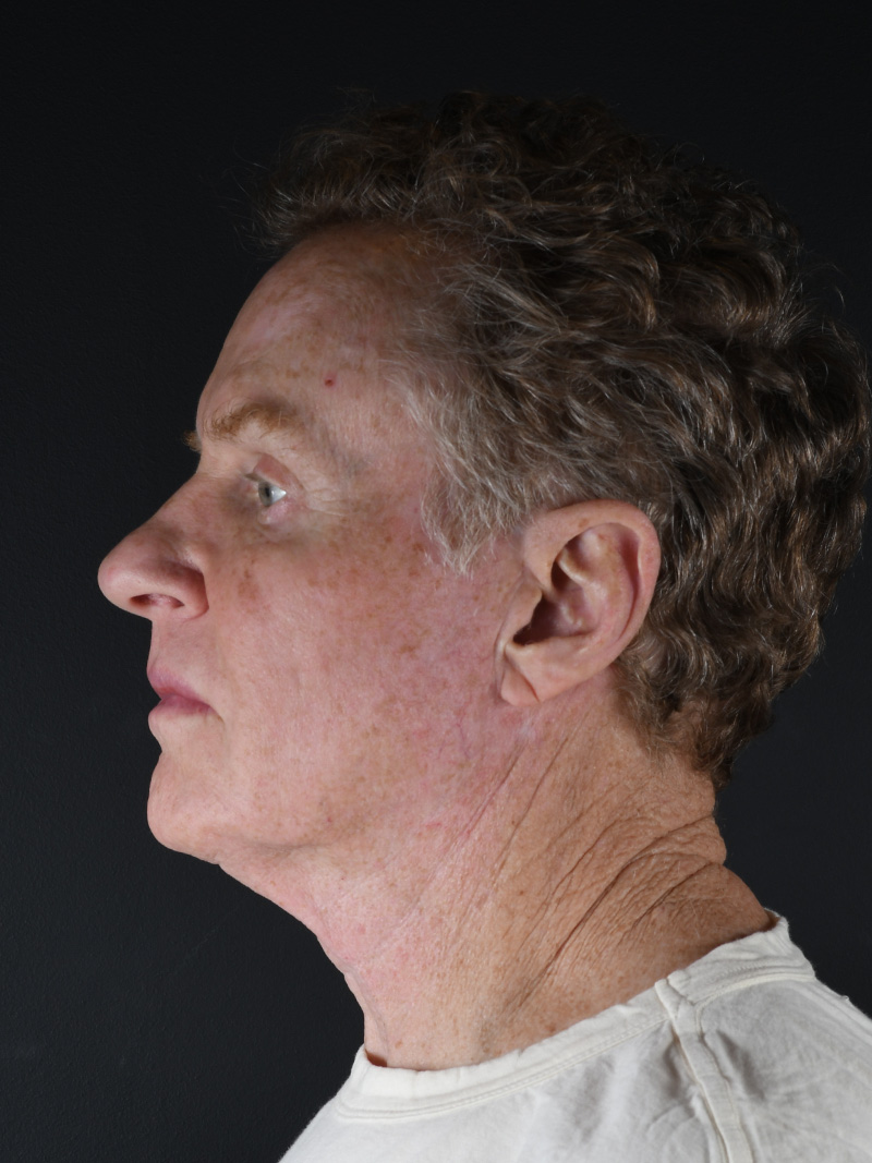 Natural Browlift Before and After | Northside Plastic Surgery