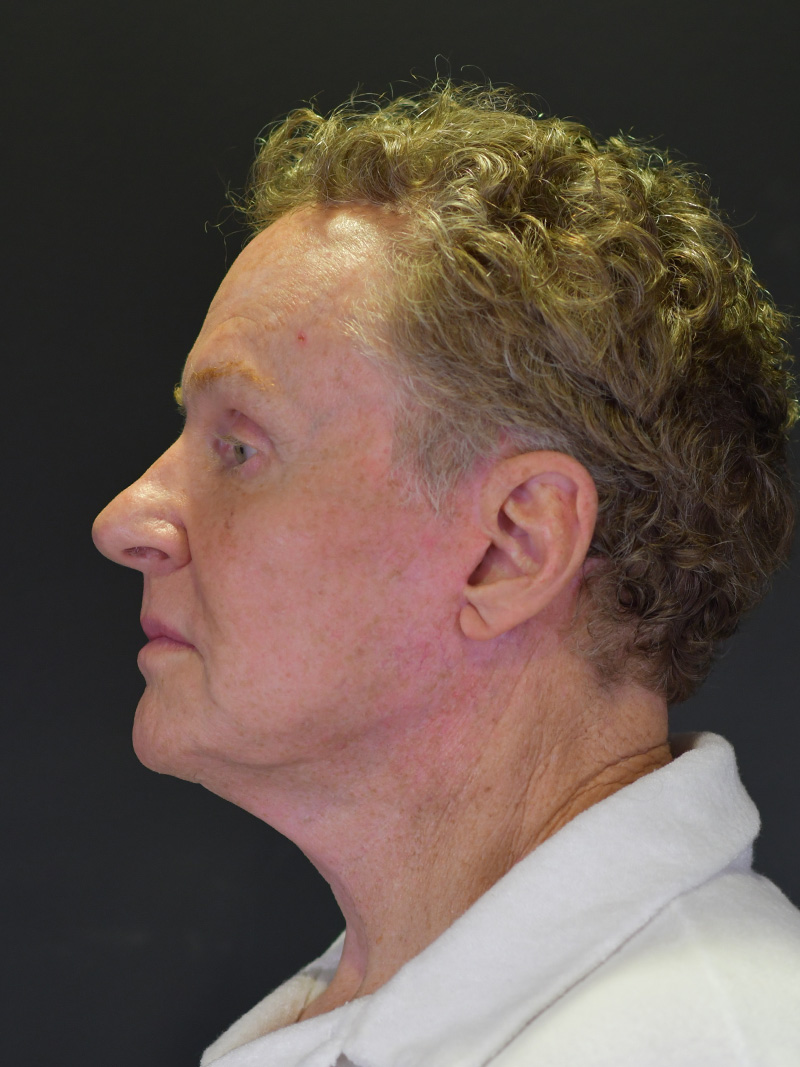 Natural Browlift Before and After | Northside Plastic Surgery