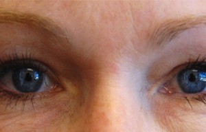 Natural Eyelid Surgery Before and After | Northside Plastic Surgery