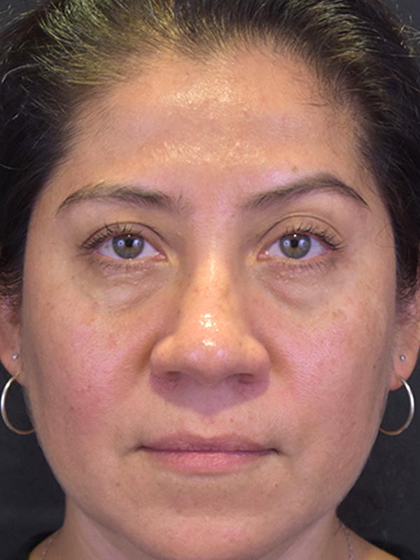 Natural Eyelid Surgery Before and After | Northside Plastic Surgery