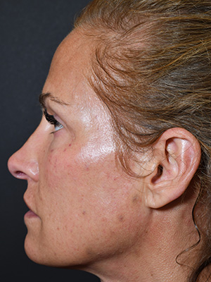 Natural Eyelid Surgery Before and After | Northside Plastic Surgery