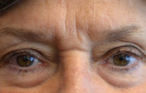 Natural Eyelid Surgery Before and After | Northside Plastic Surgery