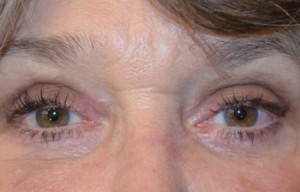 Natural Eyelid Surgery Before and After | Northside Plastic Surgery