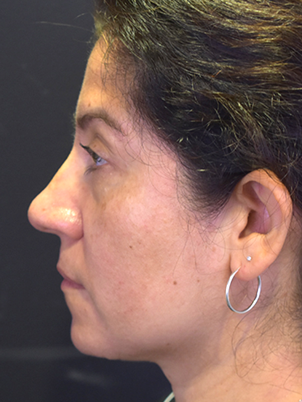 Natural Eyelid Surgery Before and After | Northside Plastic Surgery