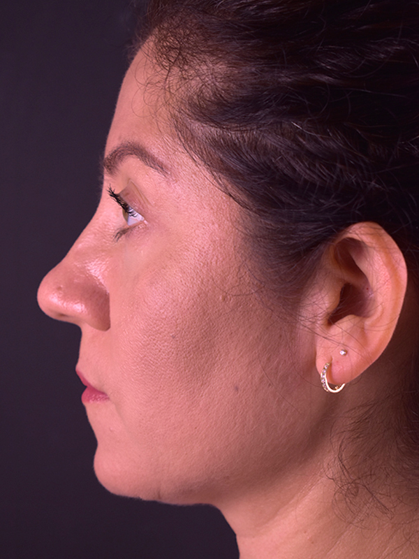 Natural Eyelid Surgery Before and After | Northside Plastic Surgery