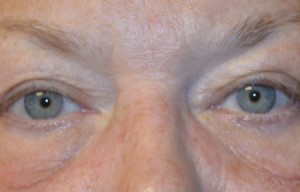 Natural Eyelid Surgery Before and After | Northside Plastic Surgery