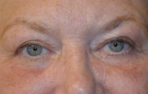 Natural Eyelid Surgery Before and After | Northside Plastic Surgery