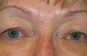 Natural Eyelid Surgery Before and After | Northside Plastic Surgery