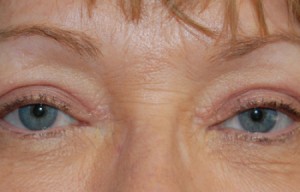 Natural Eyelid Surgery Before and After | Northside Plastic Surgery