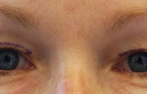 Natural Eyelid Surgery Before and After | Northside Plastic Surgery