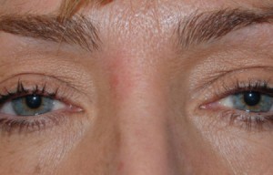 Natural Eyelid Surgery Before and After | Northside Plastic Surgery