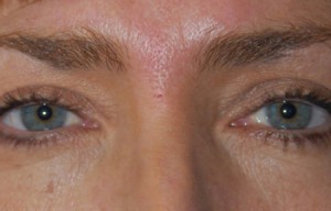 Natural Eyelid Surgery Before and After | Northside Plastic Surgery