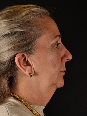Natural Eyelid Surgery Before and After | Northside Plastic Surgery