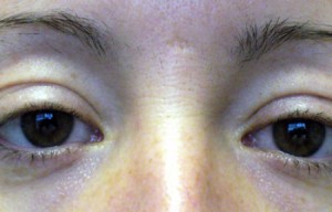 Natural Eyelid Surgery Before and After | Northside Plastic Surgery