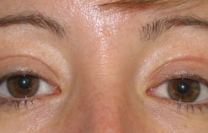 Natural Eyelid Surgery Before and After | Northside Plastic Surgery